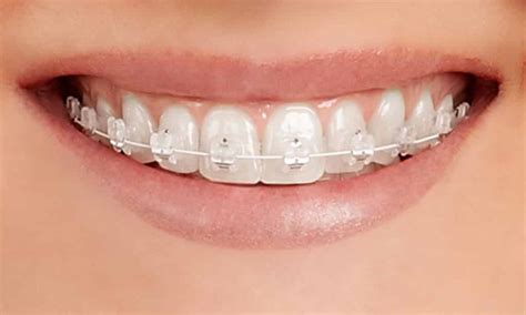 replacement clear braces